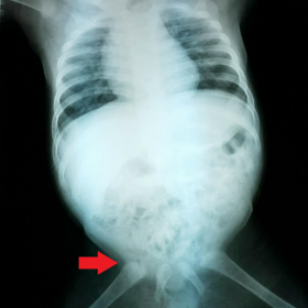 AP plain film radiograph of the chest and abdomen