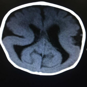 Smooth agyral temporo-parietal and occipital lobes