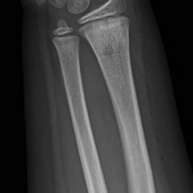 Conventional radiograph of the right wrist