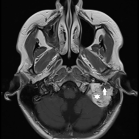 Axial T1-WI after intravenous administration of gadolinium-based contrast medium