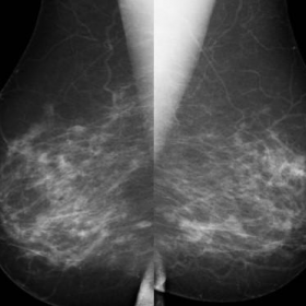 Medio-lateral oblique (MLO) bilateral images.