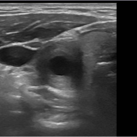 Axial image of the right CCA