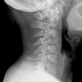 Lateral neck radiograph