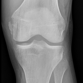 Anteroposterior radiograph of the left knee