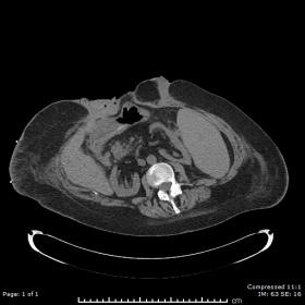 Axial CT scan slice (non-contrast).