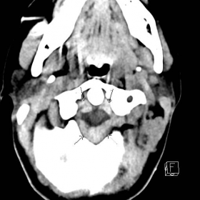 Axial non-enhanced CT through the craniocervical junction