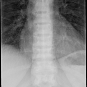 Frontal radiograph of the thoracic spine