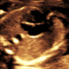 Prenatal ultrasound of heart
