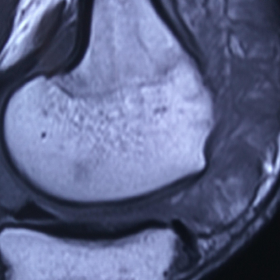 Sagittal T1WI MRI of left knee