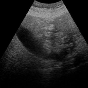 Bedside abdominal ultrasound at emergency admission