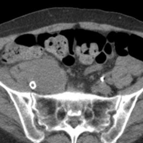 Unenhanced axial CT of the urinary tract