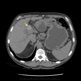 Unenhanced CT abdomen