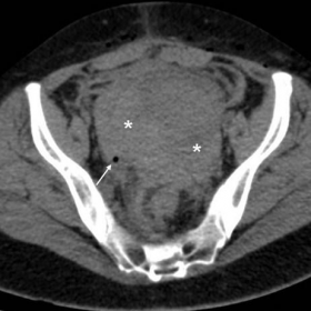 Unenhanced and post-contrast multidetector CT