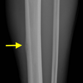 Plain radiography of the leg