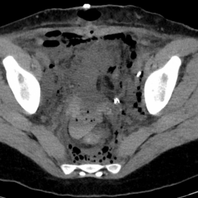 Axial non-enhanced CT of the pelvis.