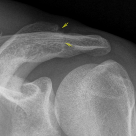 Conventional radiograph of the left shoulder