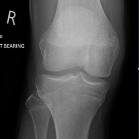 Radiographs of the right knee