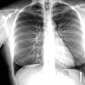 Plain radiography of the chest