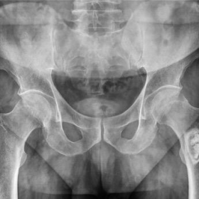 Plain X-ray film. Bilateral hips.