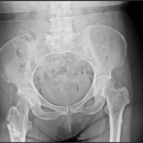 AP radiograph of the pelvis - right subtrochanteric fracture