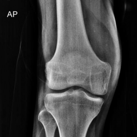 Plain radiograph of knee AP and Lateral view