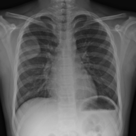 Chest PA radiograph
