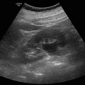 Figure 1  Coronal/length view right kidney