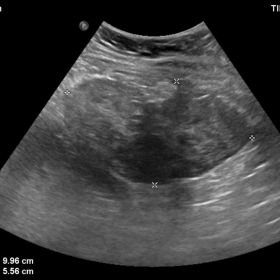 Ultrasound Pelvis
