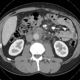 Axial computer tomography images, retroperitoneal haematoma