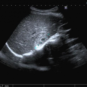 Figure 1: Abdominal Ultrasound.