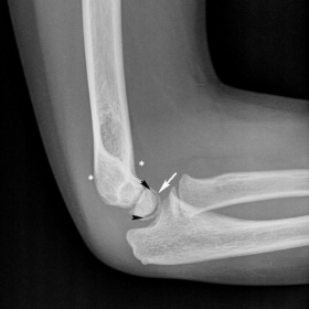 Conventional radiograph of the right elbow, lateral and anteroposterior view