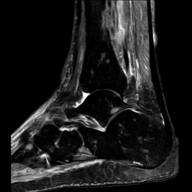 MRI of right ankle