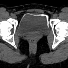CT scan (bladder)
