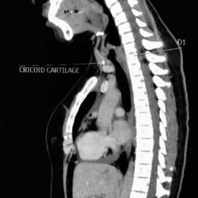 Sagittal CT image