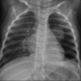 Chest x-ray showing two masses