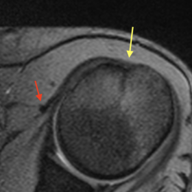 Axial GRE T2-weighted image depicting empty hypoplastic left bicipital groove (yellow arrow) consistent with agenesis of the 