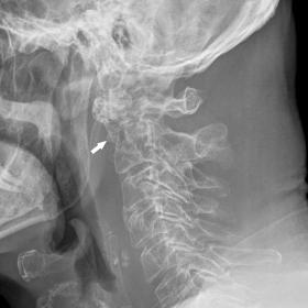 Cervical spine X-ray, sagittal view. Lytic lesion of the odontoid process with pathologic fracture (white arrow).