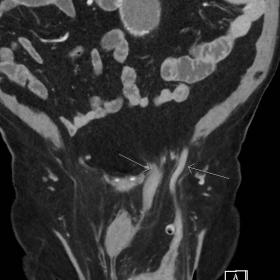 Coronal contrast-enhanced CT in portal venous phase. Arrows point to inguinal hernia containing sigmoid colon. There is peric