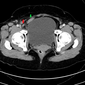 Axial CT image of the pelvis. The appendix (red arrow) is seen adjacent to the terminal ileum (green arrow) with minimal free