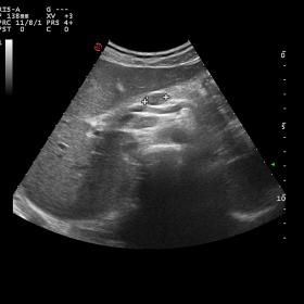 US B-mode image shows minimally enlarged liver with normal homogeneous echotexture, without focal lesions; some perihepatic r