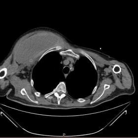 Non-enhanced CT of the thorax, observing a hypodense lesion surrounding the bypass