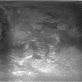 Extraescrotal and perineal haematoma. Heterogeneous area in the perineal region without colour Doppler flow.