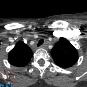 Contrast-enhanced chest CT scan (a: arterial phase; b-f: venous phase) shows a soft-tissue attenuation non-calcified mass in 