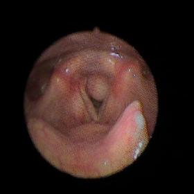 Nasopharyngolaryngoscopy image revealing a rounded subglottic lesion, which occupies the left glottic cleft