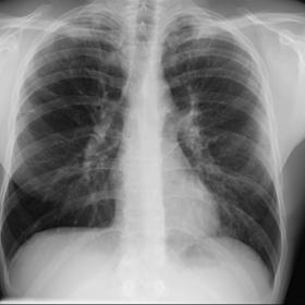 PA and lateral chest radiographs report subtle peripheral opacities with apical predominance