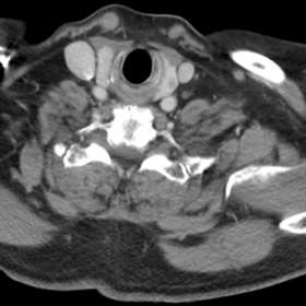 Hypovascular thyroid nodule in the left lobe, incidental finding.