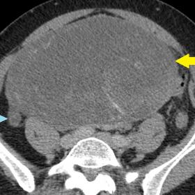 Axial contrast enhanced multi-detector CT image showing a large multiloculated cystic mass in pelvis (Hounsfield units 16) wi