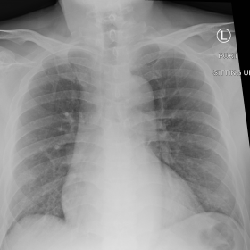 AP chest X-ray at initial presentation demonstrated mild patchy increased interstitial markings at the bilateral lung bases w