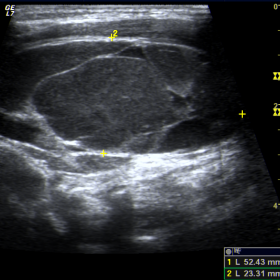 Ultrasound of the left cervical region shows a hypoechoic lesion with regular margins and multiple internal septa, with over 