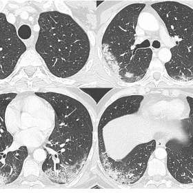 Chest CT of patient one showing bilateral ground-glass opacities with tendency to consolidation and crazy paving with lower l